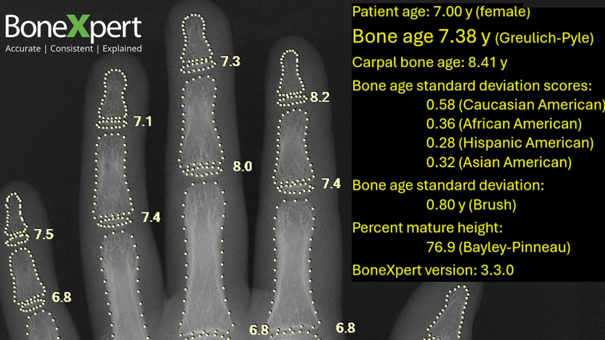 Visiana骨龄软件BoneXpert获FDA 510(k)（K262390）：5中心1285张手片，RMSE 0.55年对医师0.76年