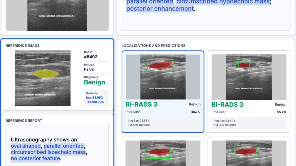 npj Digital Medicine：B-RAD乳腺超声多模态检索增强模型，7国11队列8311图验证，活检分流AUROC 0.952