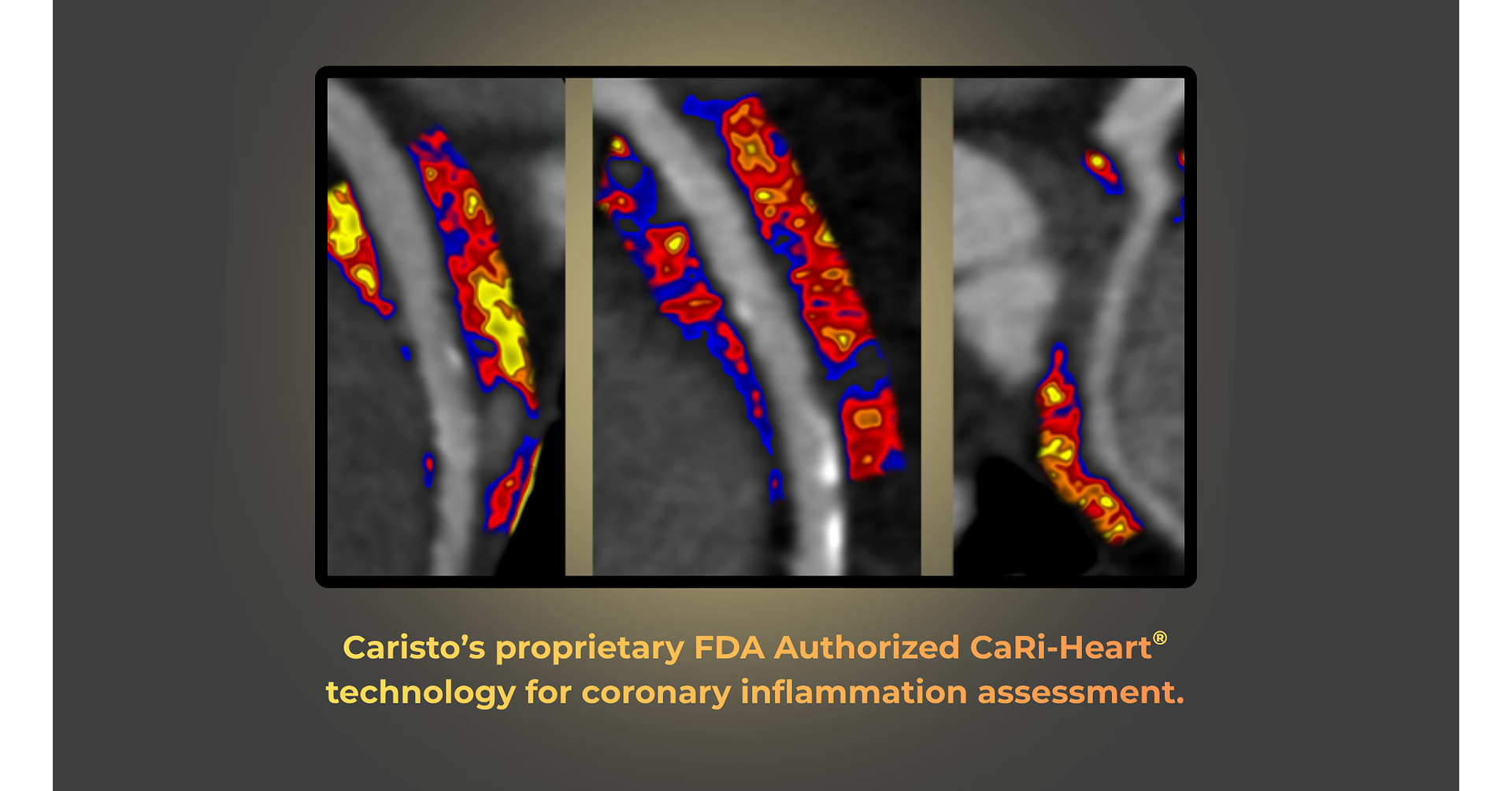 Caristo 的 AI 冠脉炎症量化技术获得 FDA De Novo 授权