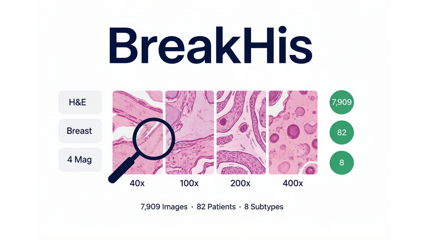 BreakHis — 乳腺癌组织病理图像数据库 AI-Ready Wikipedia | 千方病案医数集