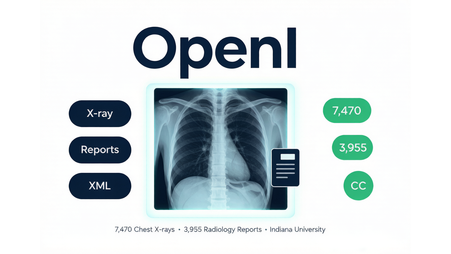 OpenI / IU X-ray — 经典胸片-报告图文对数据集 AI-Ready Wikipedia | 千方病案医数集