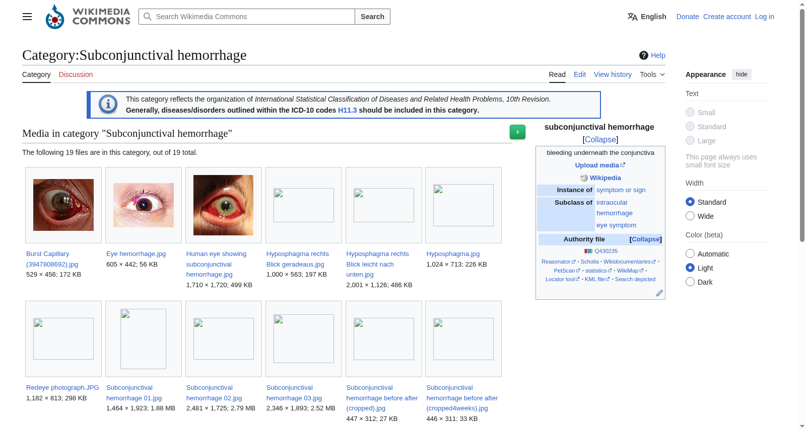Wikimedia结膜下出血图像