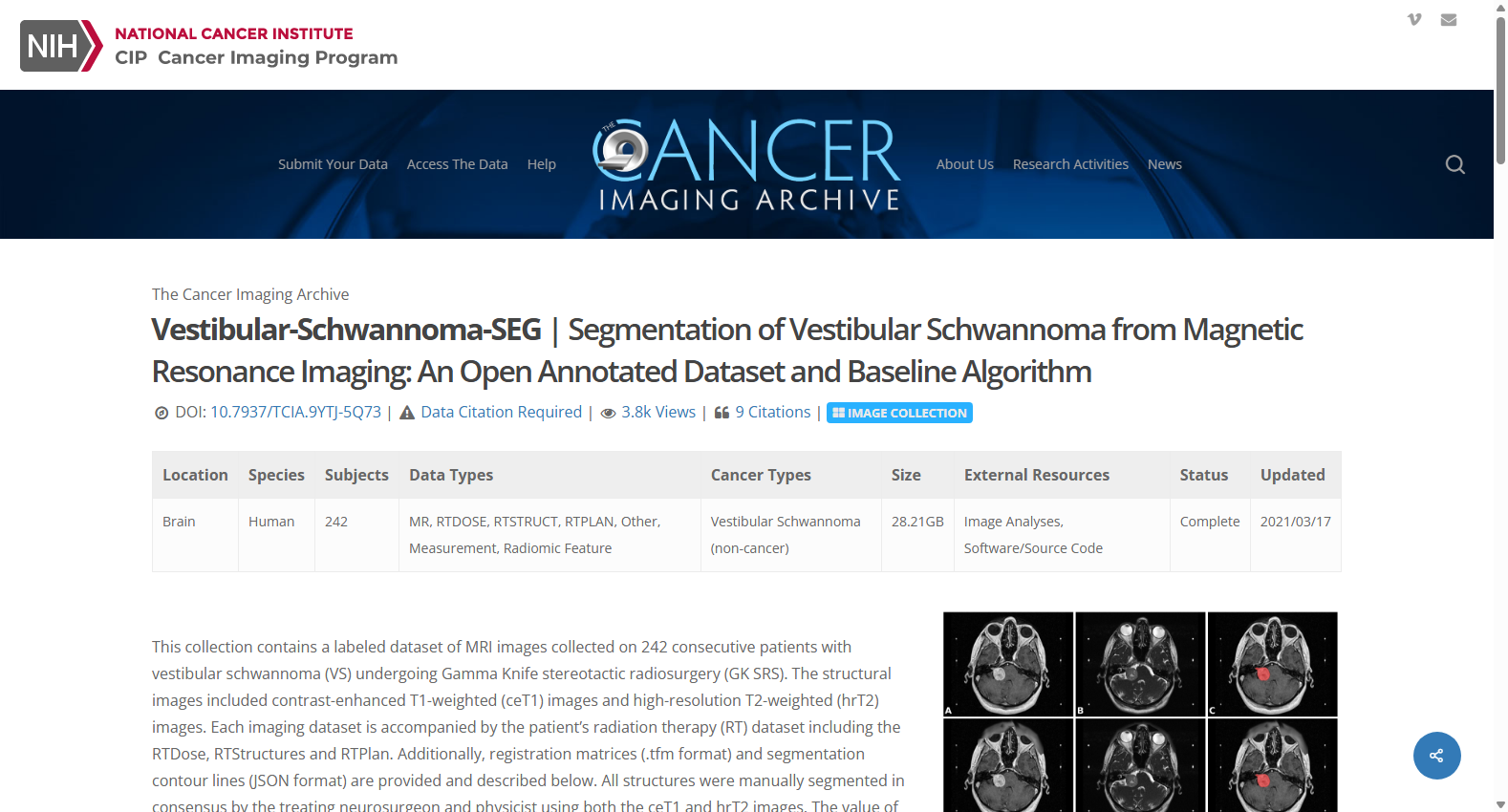VESTIBULAR-SCHWANNOMA-SEG