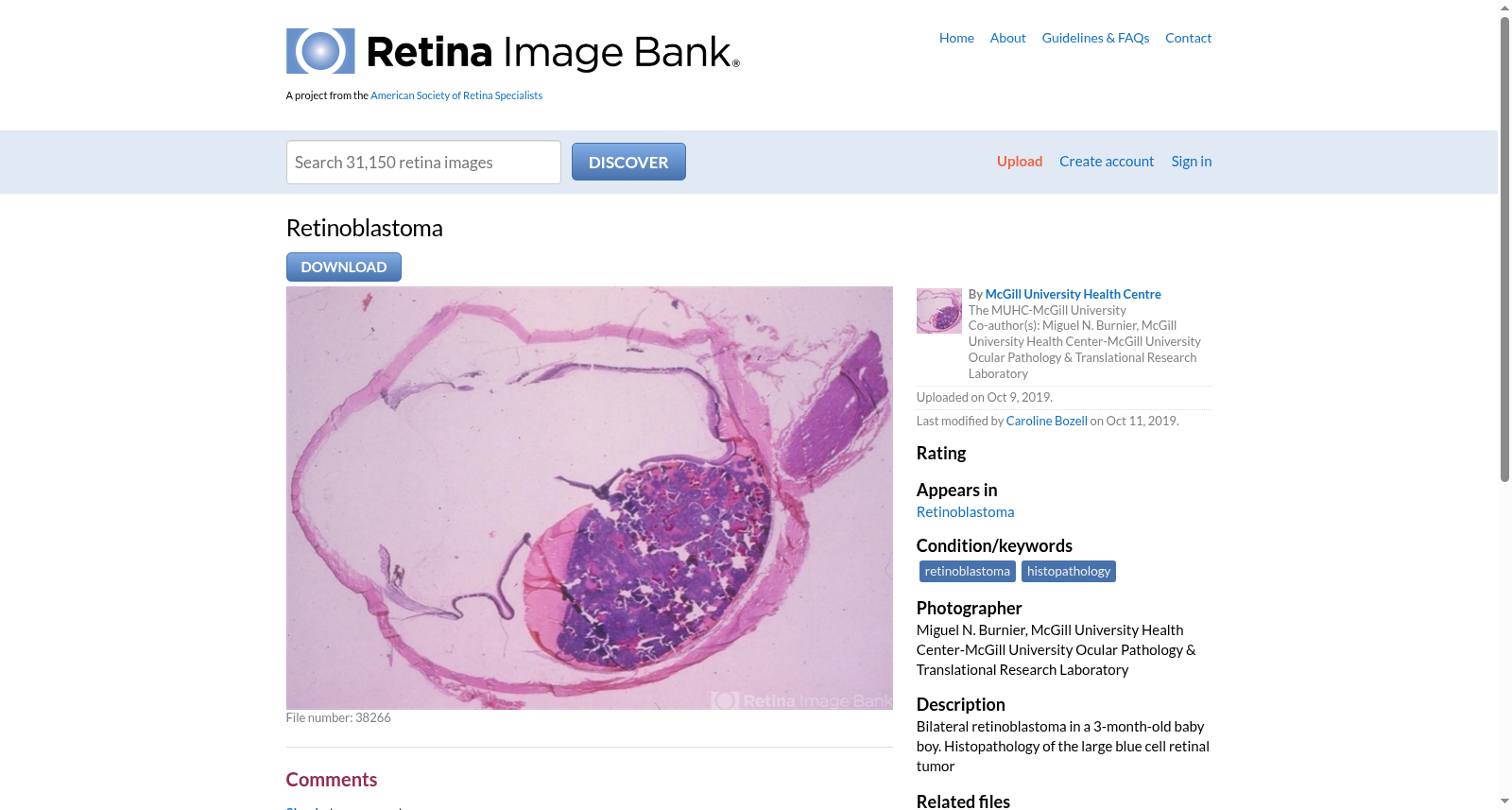 Retinoblastoma Retina Image Bank