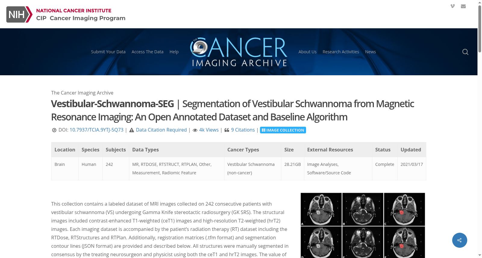 前庭神经鞘瘤磁共振成像分割数据集（Vestibular-Schwannoma-SEG）