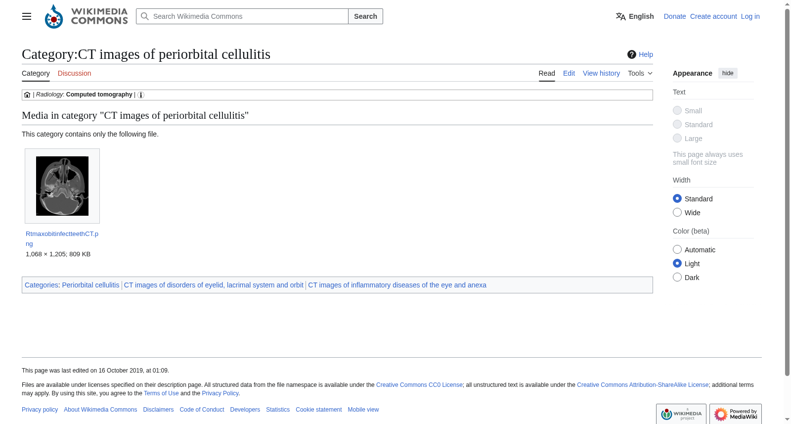 Wikimedia眼眶蜂窝织炎CT图像