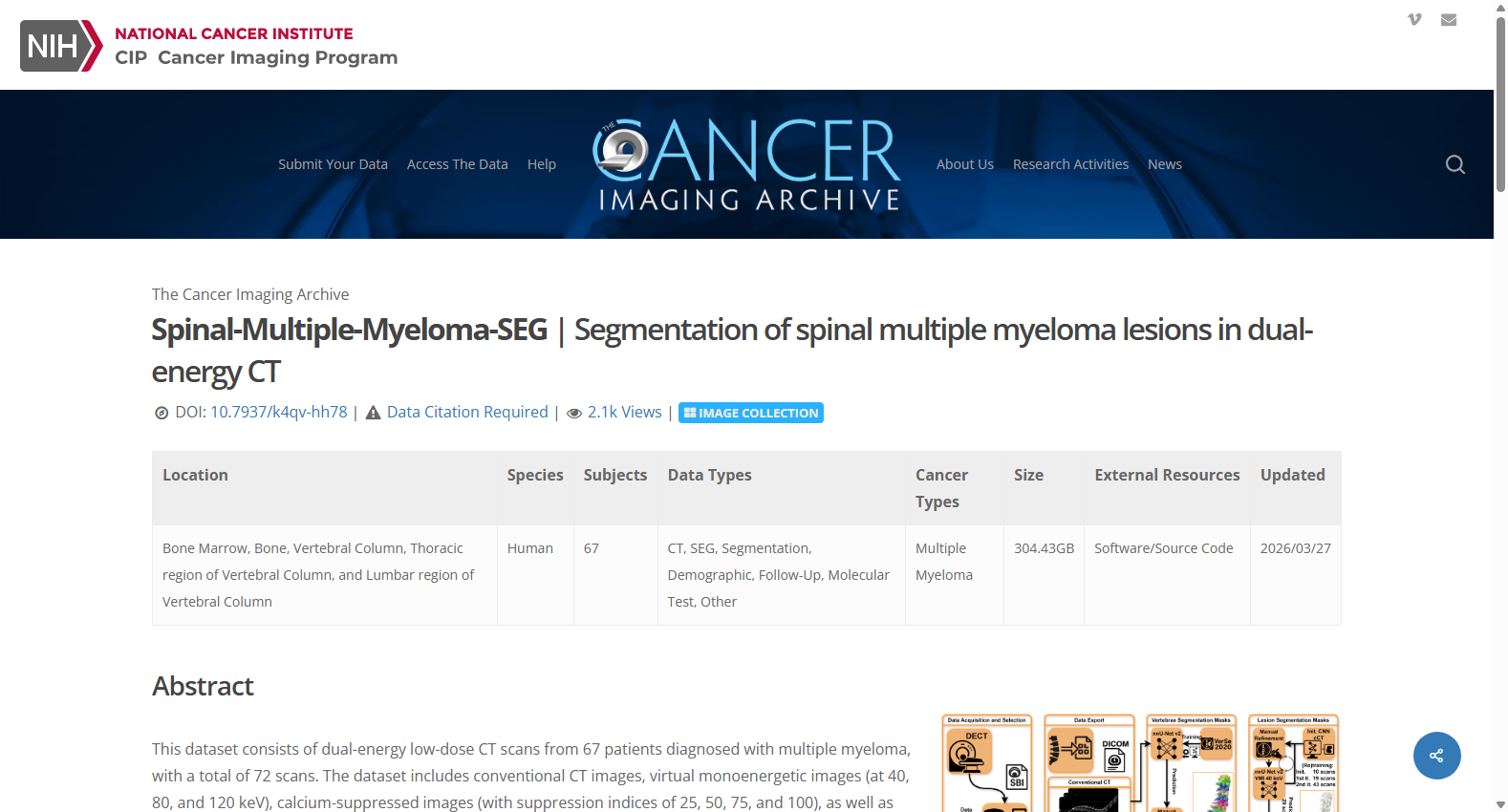Spinal-Multiple-Myeloma-SEG